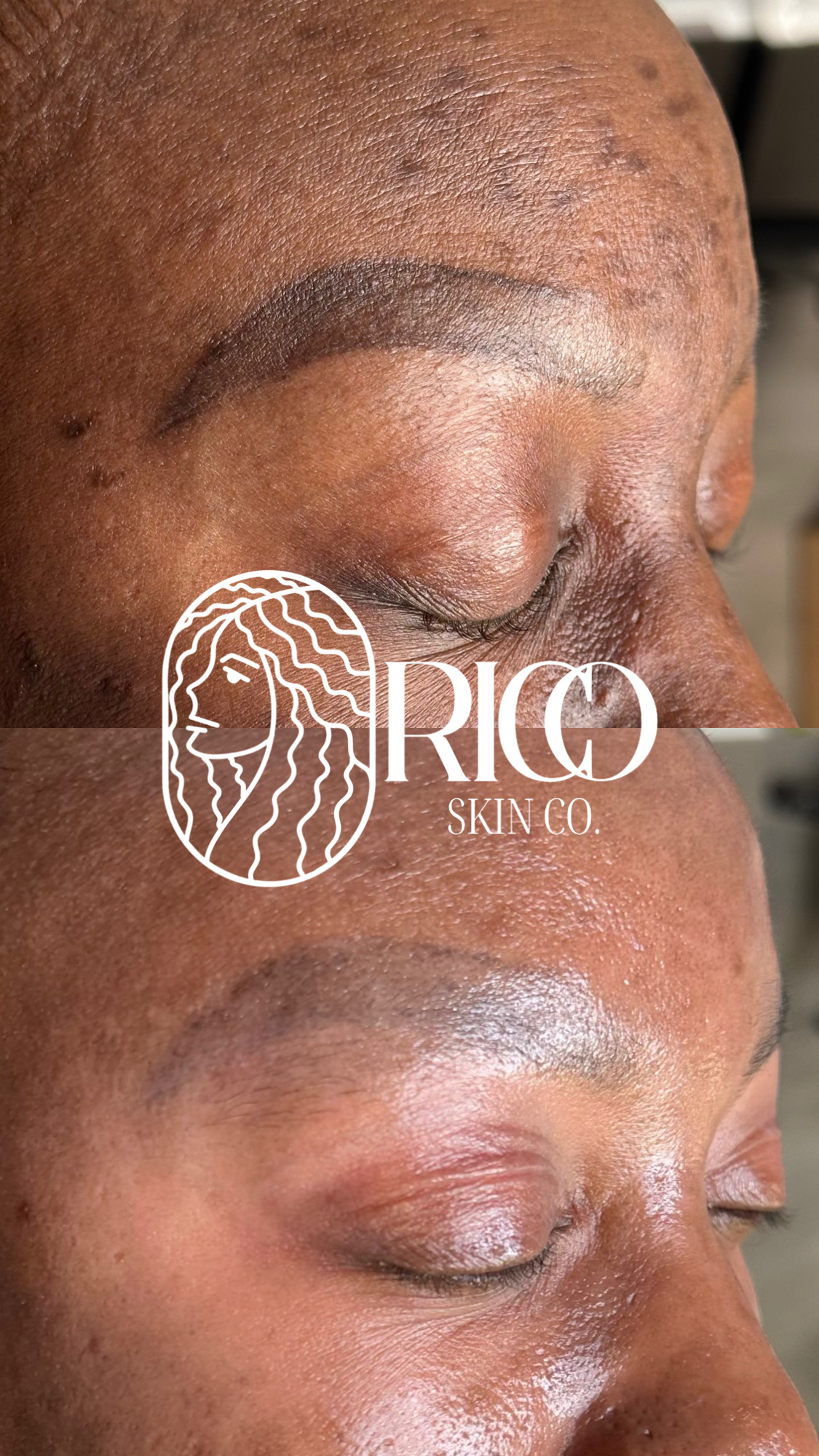 Close-up of a person's face showing skin with hyperpigmentation and scars, eyes closed, with logo overlay.