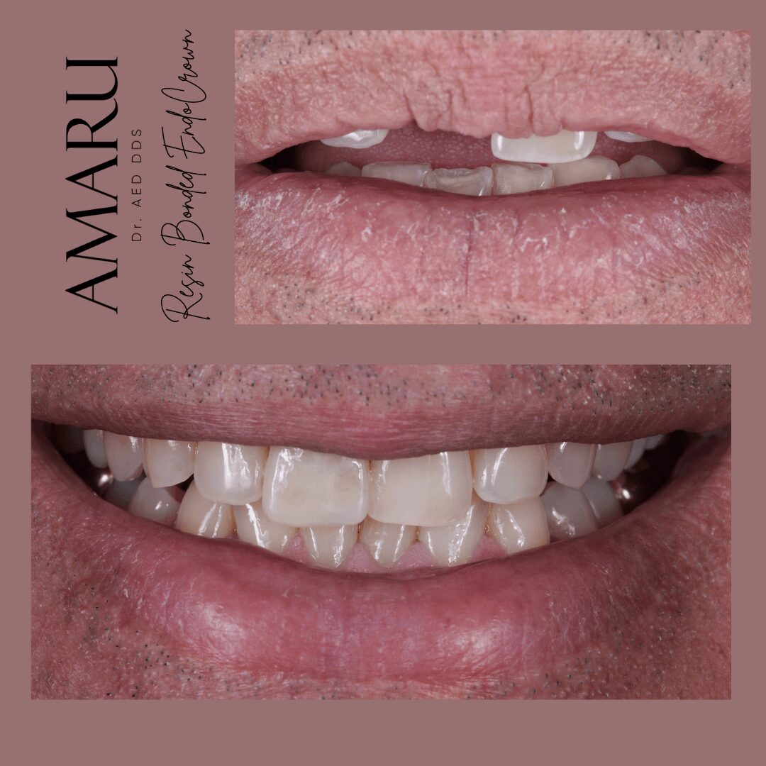 Close-up of lips and teeth, showing dental work and natural teeth, with text on the left side.