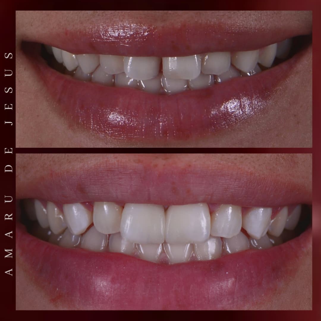 Close-up of a person's smile showing teeth before and after dental treatment, with visible improvement in alignment and appearance.