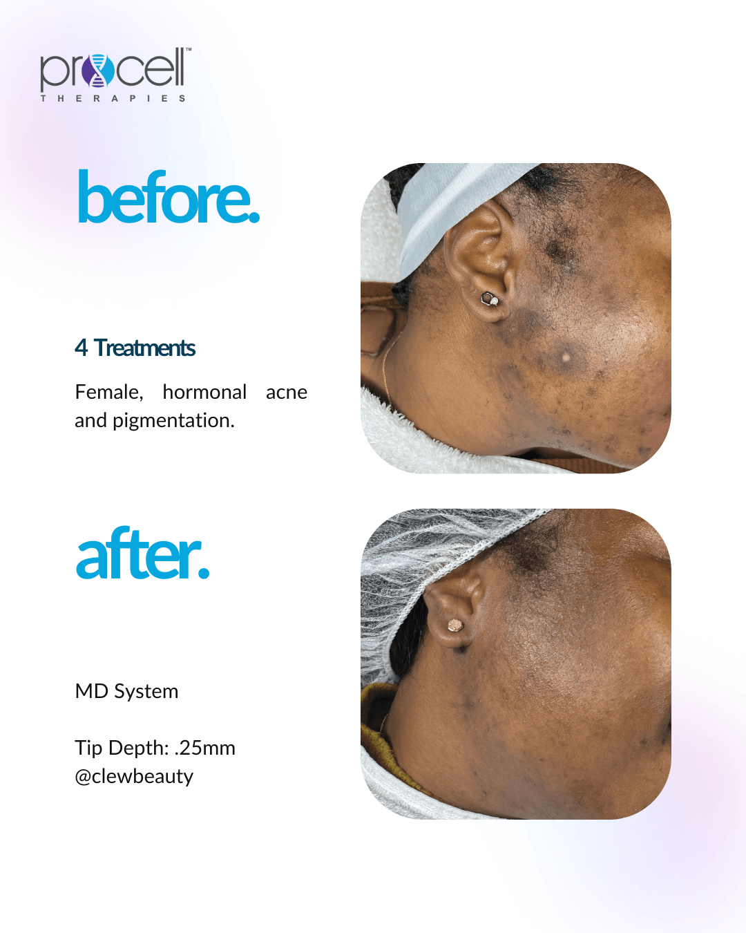 Comparison of skin before and after treatment showing improvement in acne and pigmentation, with visible skin clarity and reduced blemishes.