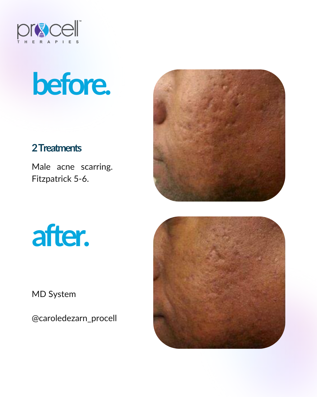 Comparison of skin before and after treatment showing reduced acne scars, with visible improvement in skin texture.