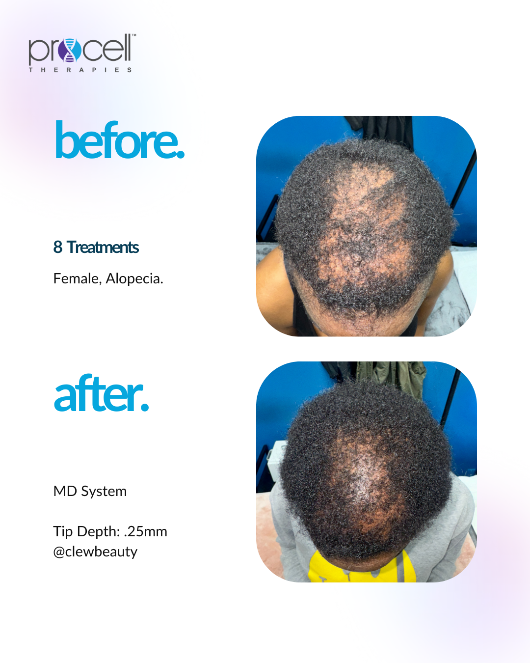 Comparison of scalp before and after treatment showing hair regrowth, with text describing treatment details and system used.